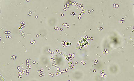 Microscopic view of HPV virus